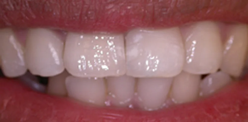 After Dental Implants