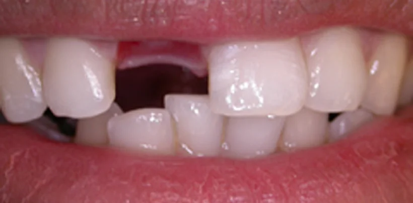 After Dental Implants